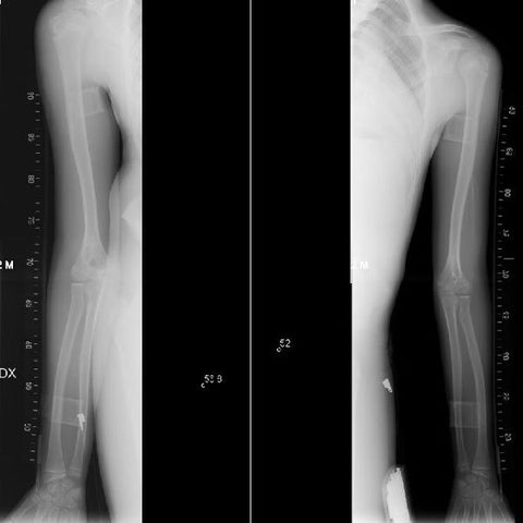 AngleMarker – ein sicheres Mass